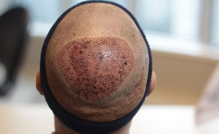 Wie Erfolgt Die Haartransplantation Fur Angstpatienten