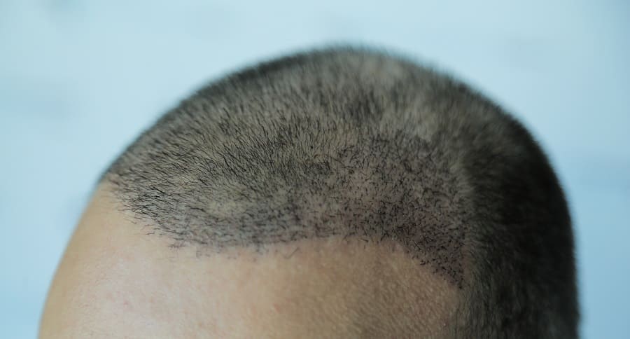 Durch Neueste Methoden Bei Haartransplantationen Narben Vermeiden